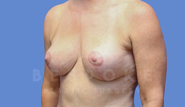 Breast Lift (No Implants) Before & After Gallery - Patient 4757638 - Image 4
