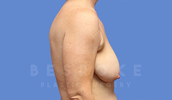 Breast Lift (No Implants) Before & After Gallery - Patient 4757638 - Image 5