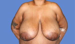 Before and After Breast Reduction in Charlotte, NC