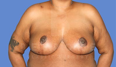 Breast Reduction Before & After Gallery - Patient 4757643 - Image 2