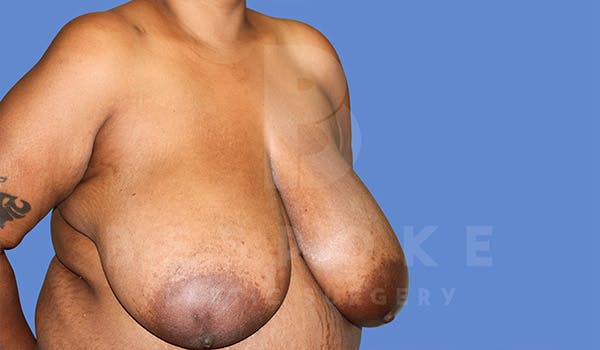 Breast Reduction Before & After Gallery - Patient 4757643 - Image 3
