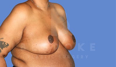 Breast Reduction Before & After Gallery - Patient 4757643 - Image 4