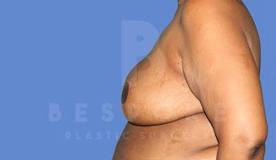 Breast Reduction Gallery - Patient 4757643 - Image 6