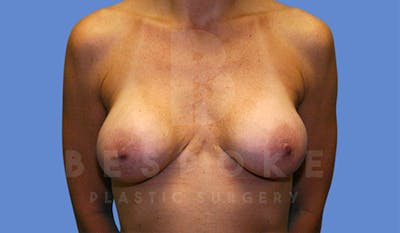 Breast Revision Surgery Before & After Gallery - Patient 4815683 - Image 1