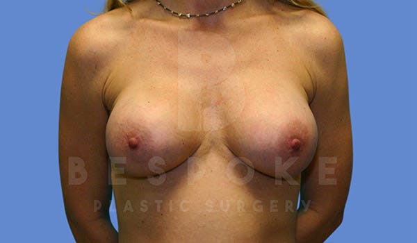 Breast Revision Surgery Before & After Gallery - Patient 4815683 - Image 2