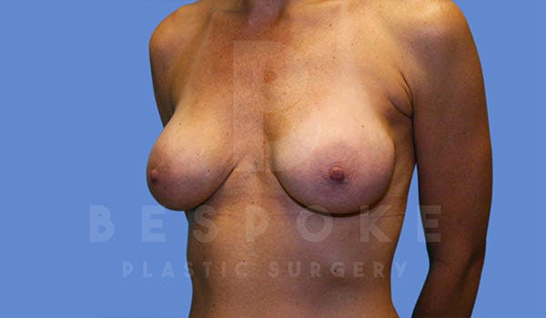 Breast Revision Surgery Before & After Gallery - Patient 4815683 - Image 3