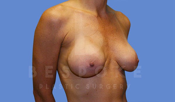 Breast Revision Surgery Before & After Gallery - Patient 4815683 - Image 5