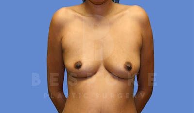 Breast Augmentation Before & After Gallery - Patient 4815687 - Image 1