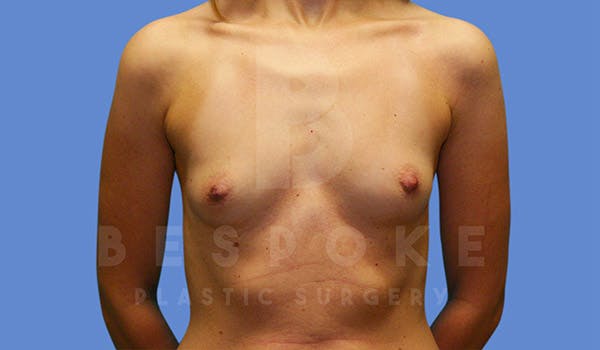 Breast Augmentation Before & After Gallery - Patient 4815688 - Image 1