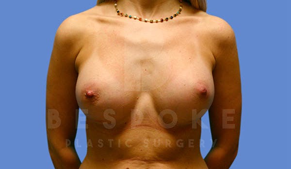 Breast Augmentation Before & After Gallery - Patient 4815688 - Image 2