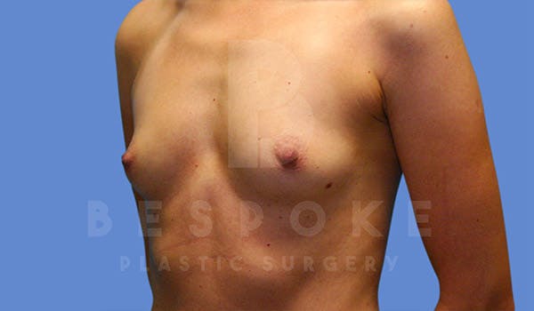 Breast Augmentation Before & After Gallery - Patient 4815688 - Image 3