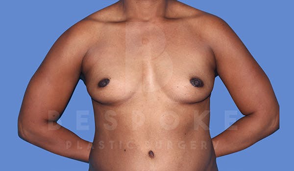 Breast Augmentation Before & After Gallery - Patient 4815689 - Image 1