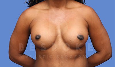 Breast Augmentation Before & After Gallery - Patient 4815689 - Image 2
