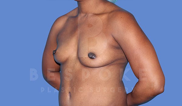 Breast Augmentation Gallery - Patient 4815689 - Image 3
