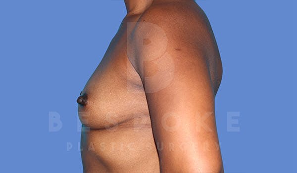 Breast Augmentation Before & After Gallery - Patient 4815689 - Image 5