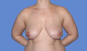 Charlotte NC Before & After Breast Augmentation with Lift