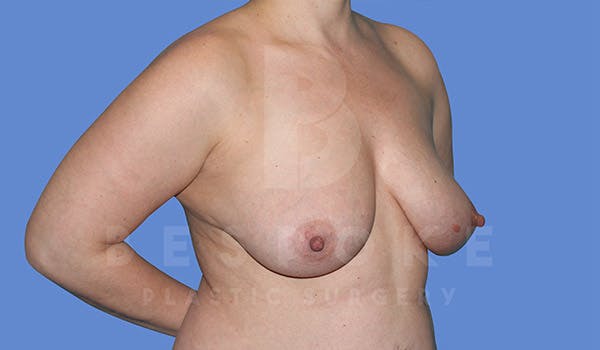 Breast Lift With Implants Before & After Gallery - Patient 4815703 - Image 3