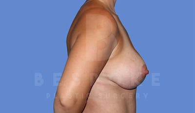Breast Lift With Implants Before & After Gallery - Patient 4815703 - Image 6