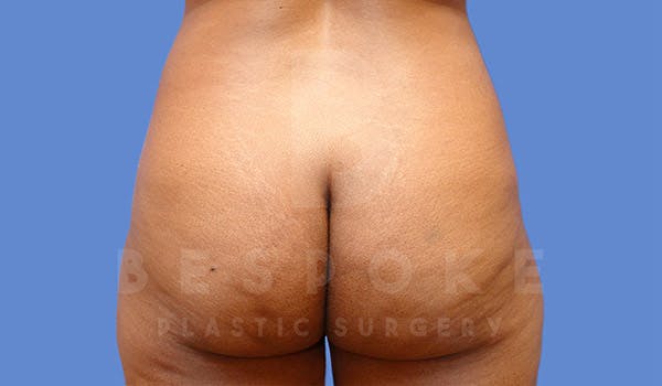 Brazilian Butt Lift Before & After Gallery - Patient 4815706 - Image 1