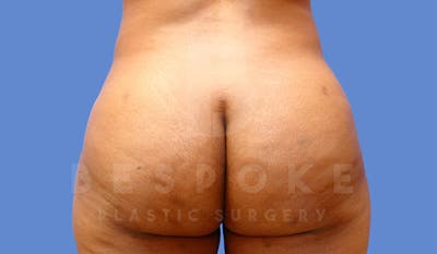 Brazilian Butt Lift Before & After Gallery - Patient 4815706 - Image 2