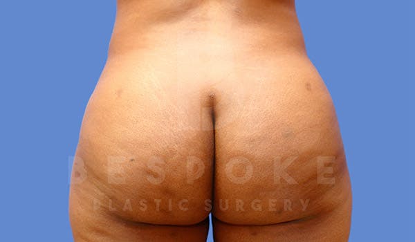 Brazilian Butt Lift Gallery - Patient 4815706 - Image 2