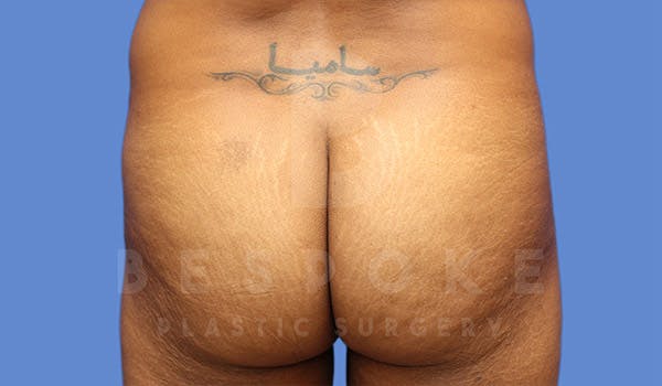 Brazilian Butt Lift Before & After Gallery - Patient 4815707 - Image 1