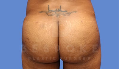 Brazilian Butt Lift Before & After Gallery - Patient 4815707 - Image 2