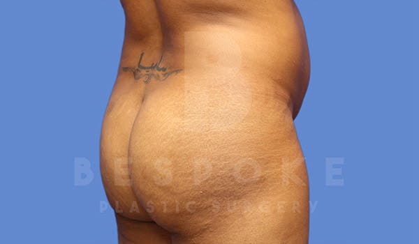 Brazilian Butt Lift Before & After Gallery - Patient 4815707 - Image 3