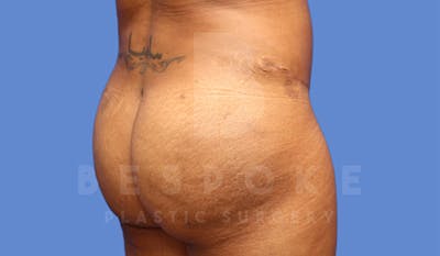 Brazilian Butt Lift Before & After Gallery - Patient 4815707 - Image 4