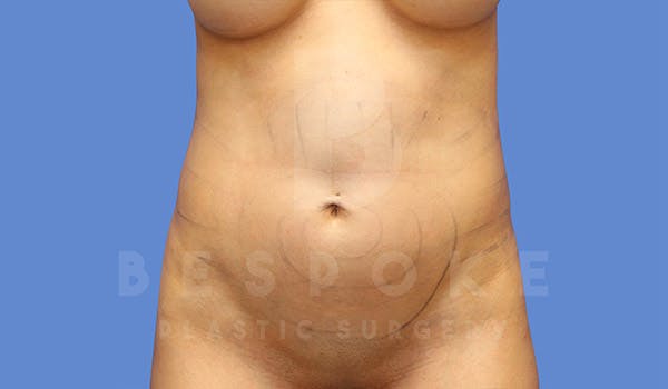 Liposuction Before & After Gallery - Patient 4815730 - Image 1