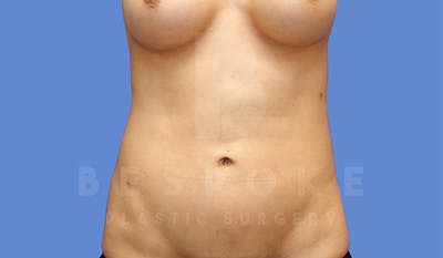 Liposuction Before & After Gallery - Patient 4815730 - Image 2