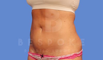 Liposuction Before & After Gallery - Patient 4815732 - Image 4