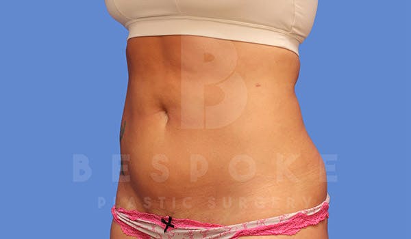 Liposuction Before & After Gallery - Patient 4815732 - Image 4