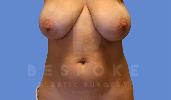 Liposuction Before & After Gallery - Patient 4815733 - Image 1