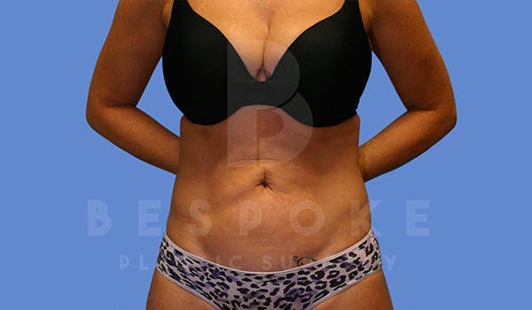 Liposuction Before & After Gallery - Patient 4815733 - Image 2