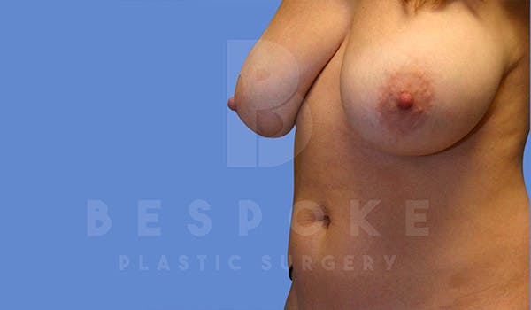 Liposuction Before & After Gallery - Patient 4815733 - Image 3