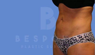 Liposuction Before & After Gallery - Patient 4815733 - Image 4