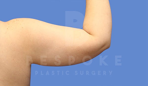 Liposuction Before & After Gallery - Patient 4815734 - Image 3