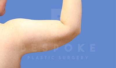 Liposuction Before & After Gallery - Patient 4815734 - Image 4