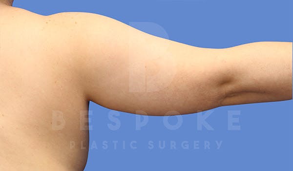 Liposuction Before & After Gallery - Patient 4815734 - Image 5