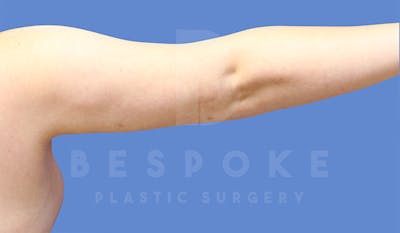 Liposuction Gallery - Patient 4815734 - Image 6