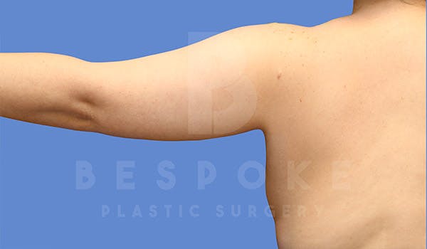 Liposuction Before & After Gallery - Patient 4815734 - Image 7