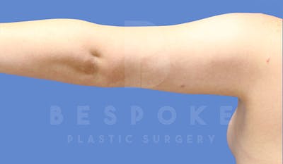 Liposuction Gallery - Patient 4815734 - Image 8