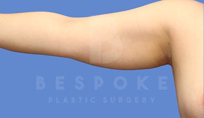 Liposuction Before & After Gallery - Patient 4815734 - Image 1