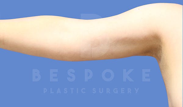 Liposuction Before & After Gallery - Patient 4815734 - Image 2