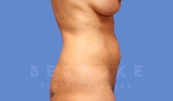High Def Lipo Before & After Gallery - Patient 4815818 - Image 1
