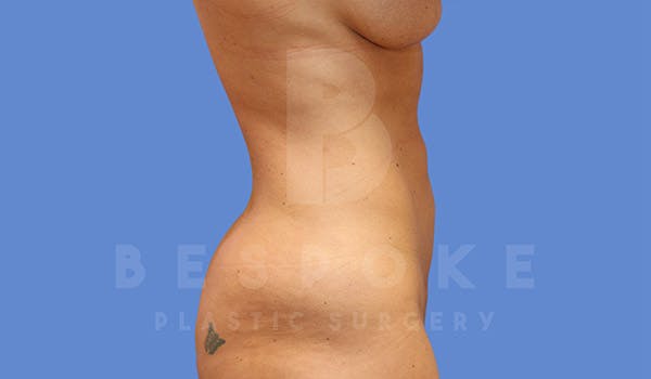High Def Lipo Before & After Gallery - Patient 4815818 - Image 2