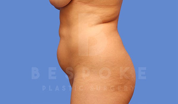 High Def Lipo Before & After Gallery - Patient 4815819 - Image 1