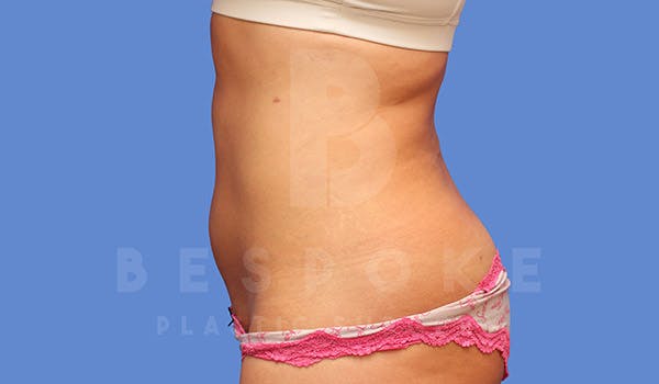 High Def Lipo Before & After Gallery - Patient 4815819 - Image 2