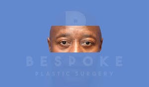 Male Eyelid Surgery